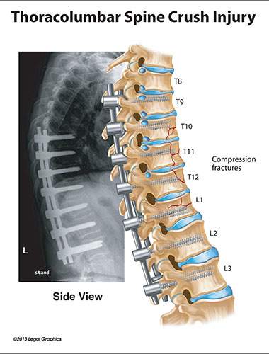 Toracolumbar Spine Crush Injury