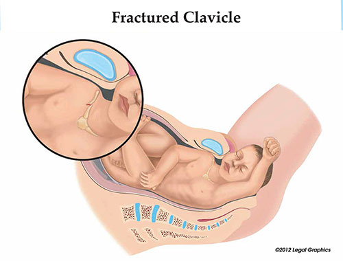 Fractured Clavicle Baby